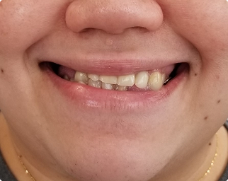 Before dentures preview