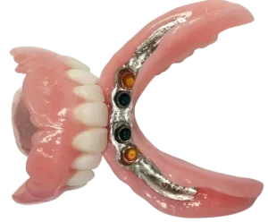 Implant supported dentures