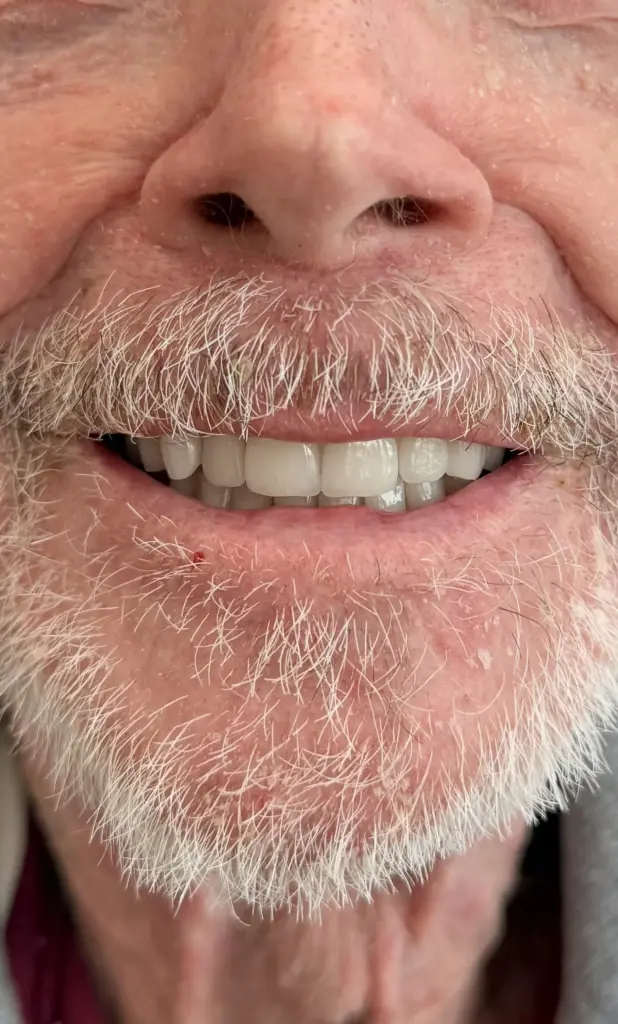 Close-up of patient's smile showing natural-looking, evenly aligned white teeth achieved with a precision denture