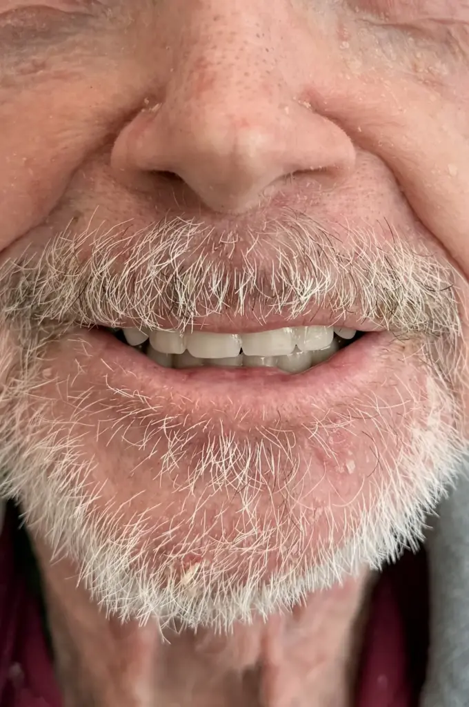 Close-up of patient's smile showing natural-looking, evenly aligned white teeth after precision denture treatment