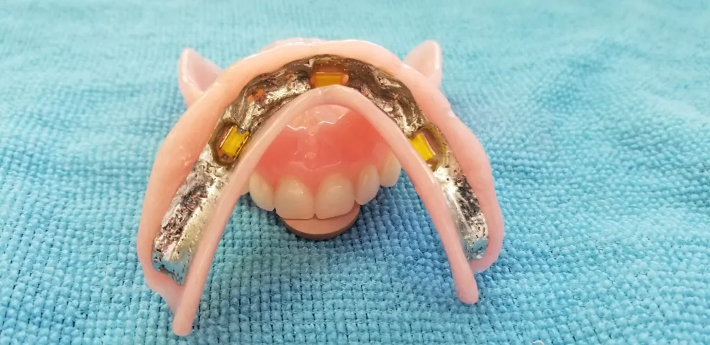 Implant dentures