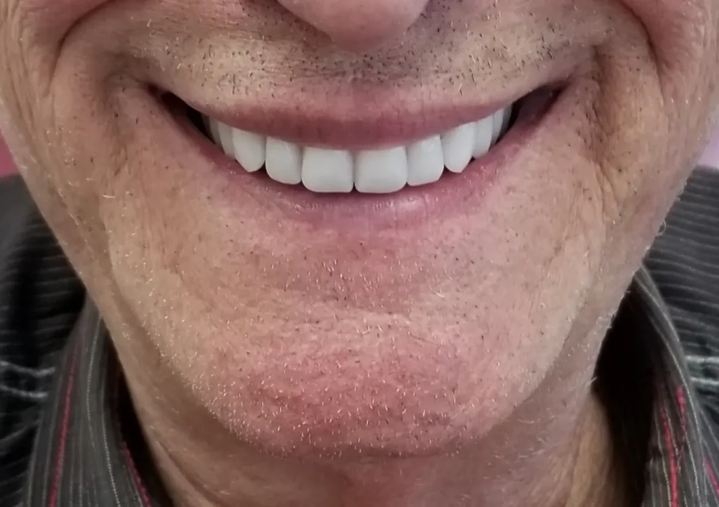 Man wearing new implant dentures